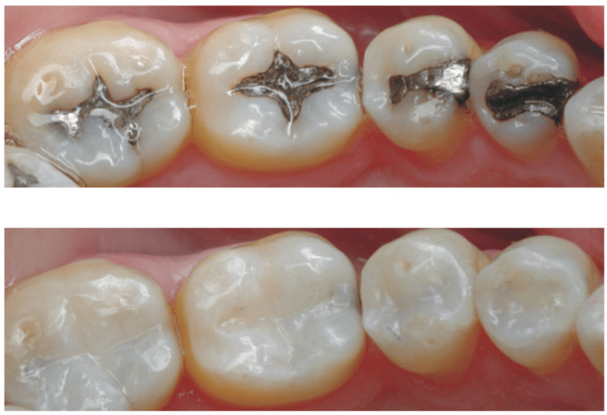 BEST CLINICAL METHODS TO AVOID POST OP SENSITIVITY IN COMPOSITE FILLINGS
