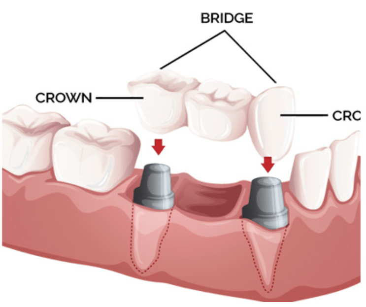 BEST AND MOST ECONOMICAL STEPS FOR CROWN AND BRIDGE PROSTHESIS.