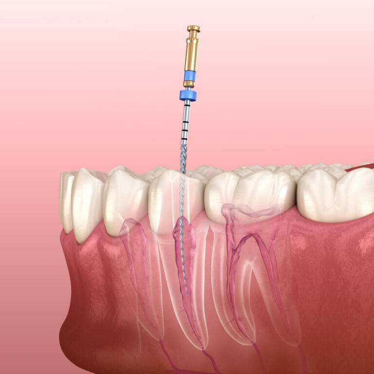 Endodontic Tips