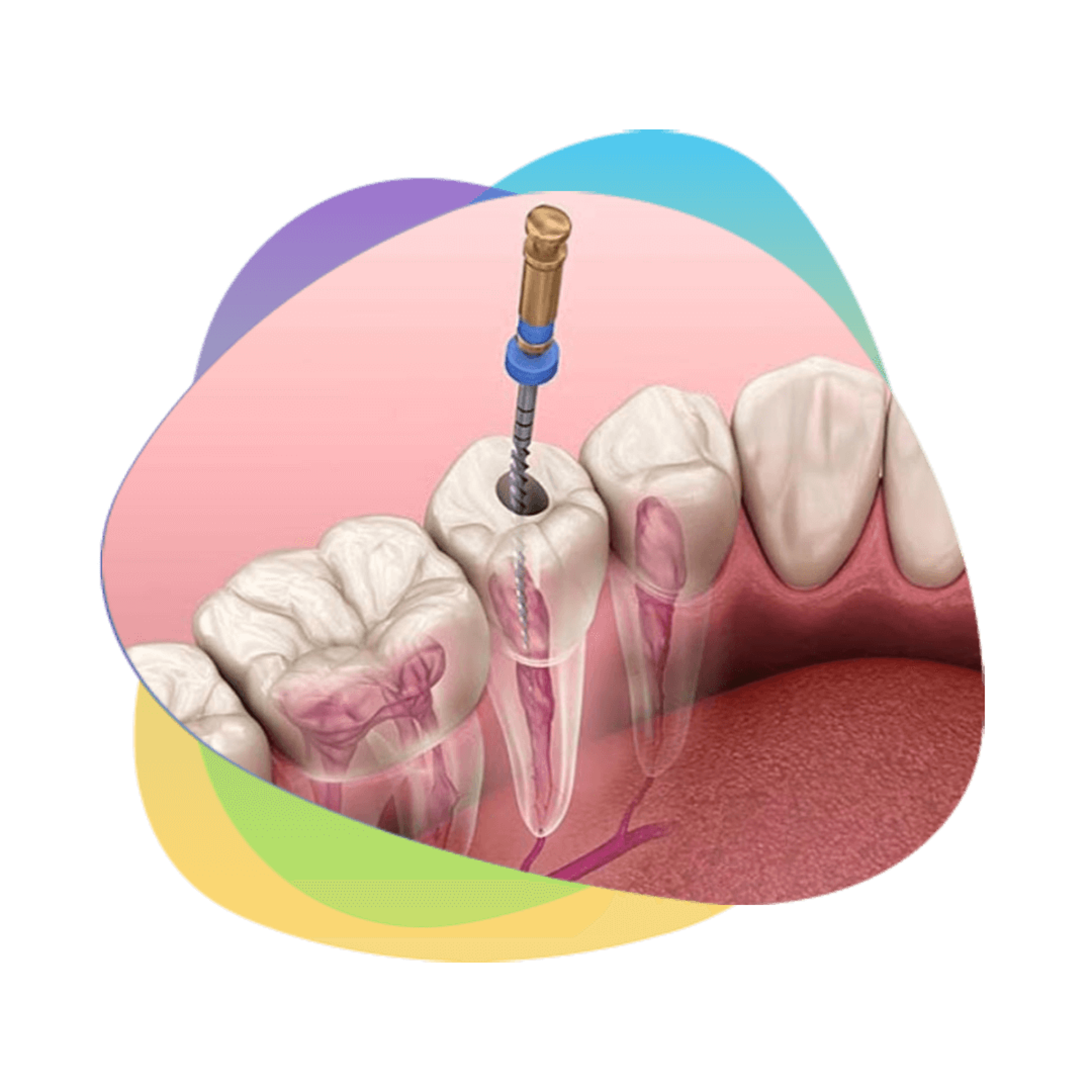 Art of predicatable endodontics