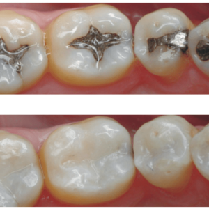 composite fillings