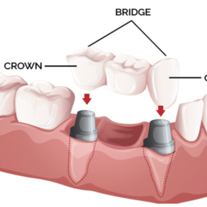 crown and bridge